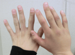 中手骨骨折の様子1