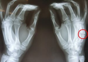 中手骨骨折の様子2